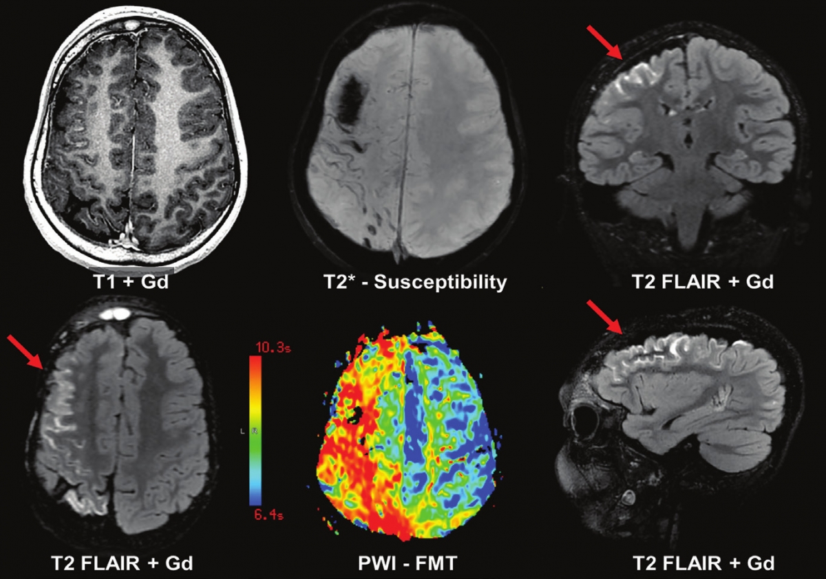 癫痫复诊时间表,癫痫服药期间复查哪些项目