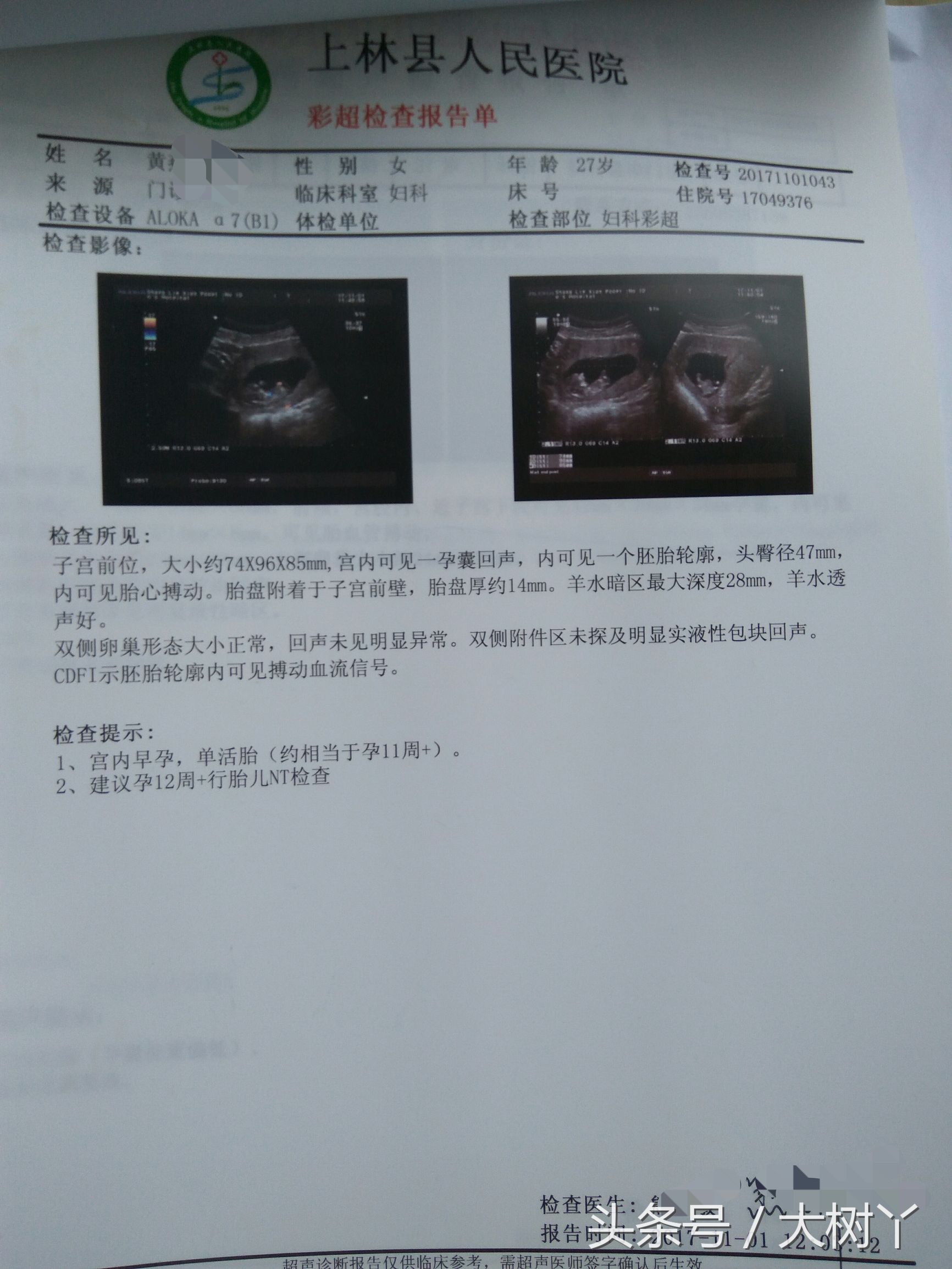 孕酮太低流血有保胎成功的吗,孕酮低保胎真实感受