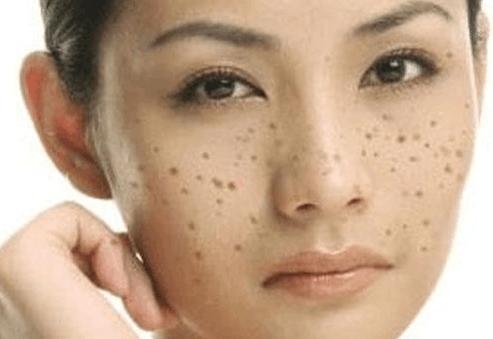 咖啡斑是真皮斑还是表皮斑,怎么分辨是真皮斑还是表皮斑