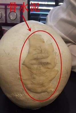 后脑勺凸起头型不好看如何矫正,什么头型让后脑勺凸起来