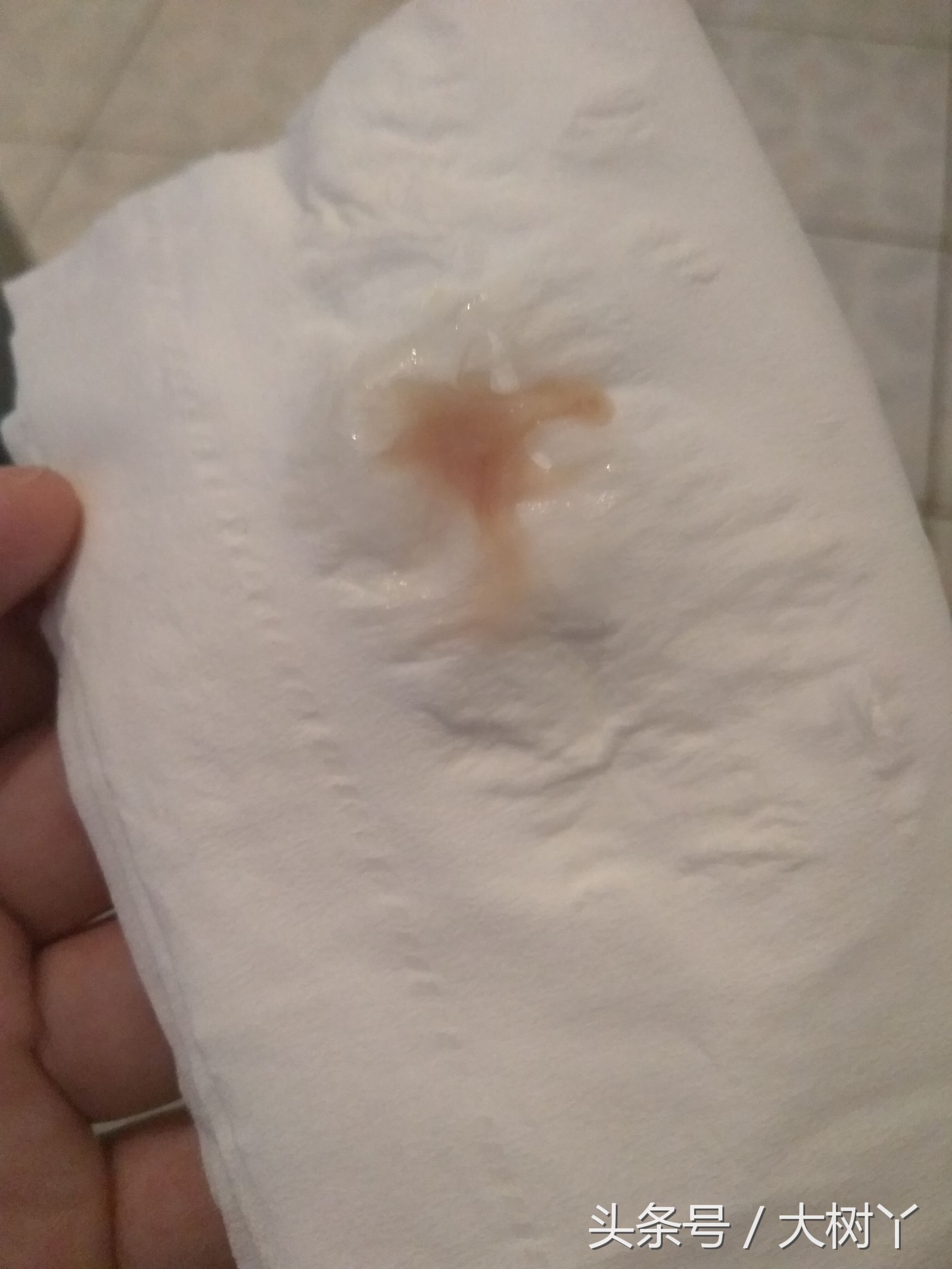 孕酮太低流血有保胎成功的吗,孕酮低保胎真实感受