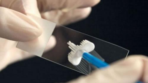 宫颈“刮片”为何悄悄改名为“涂片”？