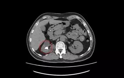 十种解决泌尿结石的方法,泌尿结石怎么缓解疼痛