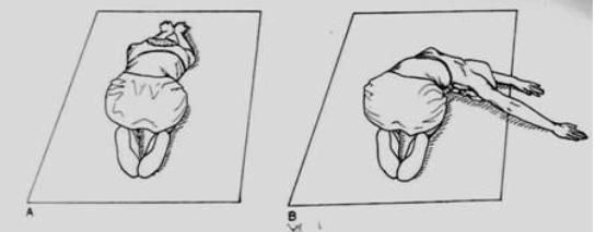 儿童先天性腰骶部脊柱侧弯,孩子弯腰驼背站不直警惕脊柱侧弯