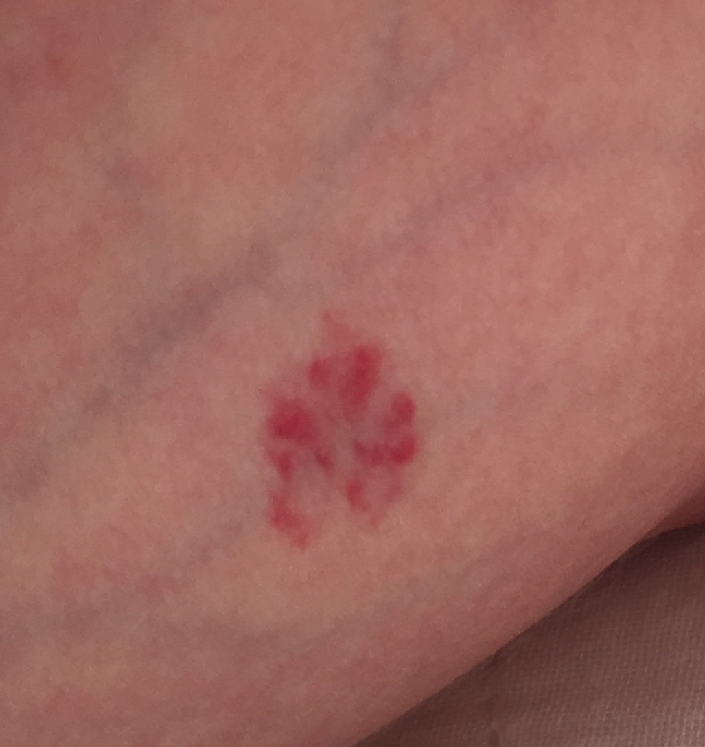 宝宝草莓状血管瘤不可怕,早发现,早治疗,附贴药操作视频