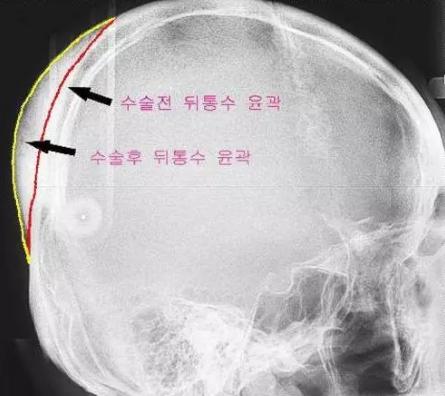 后脑勺凸起头型不好看如何矫正,什么头型让后脑勺凸起来