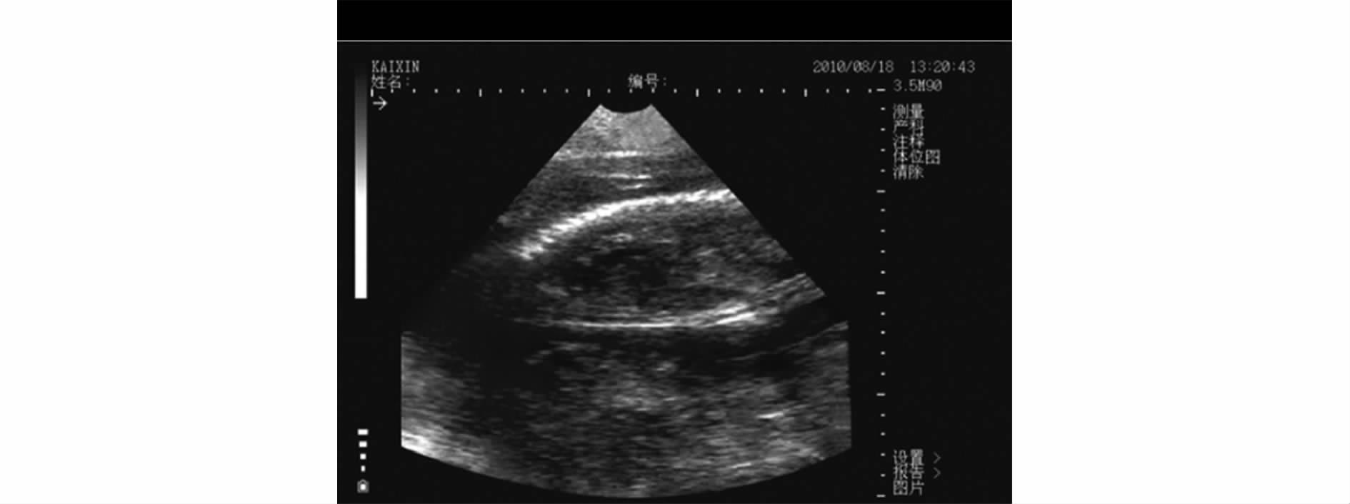 B超对猪场的生产中的应用