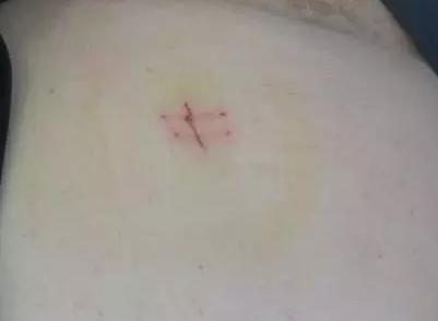 十种解决泌尿结石的方法,泌尿结石怎么缓解疼痛