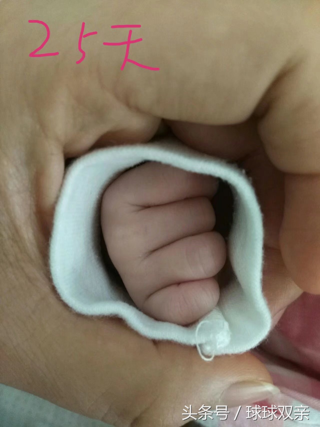 10.3日球球娘亲顺转剖经历分享