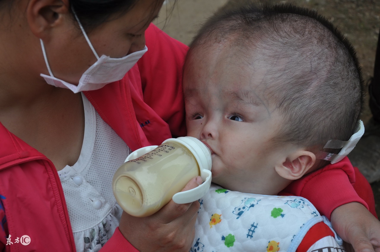小儿脑积水的护理,小儿脑积水治疗最佳方法