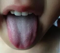 中医小儿舌诊辨证图谱,小儿舌诊辨证图谱课件