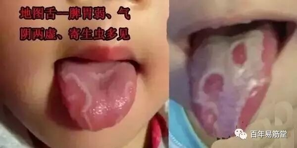 中医小儿舌诊辨证图谱,小儿舌诊辨证图谱课件