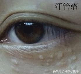脂肪粒和眼霜有关吗,脂肪粒是不是不能用眼霜