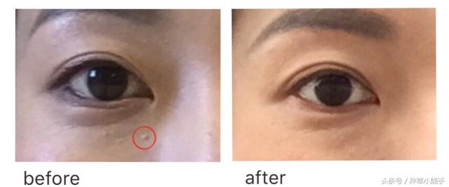 脂肪粒和眼霜有关吗,脂肪粒是不是不能用眼霜
