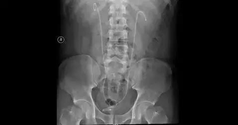 十种解决泌尿结石的方法,泌尿结石怎么缓解疼痛