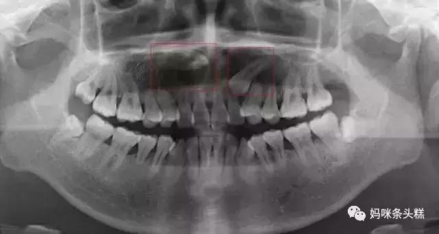 恒牙过大萌出时过早顶掉乳牙,乳牙已掉三个月怎么不长新牙