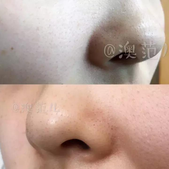 荷荷巴油去黑头使用方法,真实测评黑头粉刺