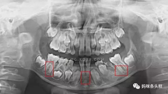恒牙过大萌出时过早顶掉乳牙,乳牙已掉三个月怎么不长新牙