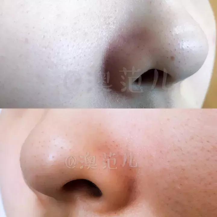 荷荷巴油去黑头使用方法,真实测评黑头粉刺
