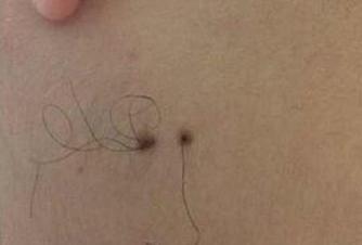 下巴有痣痣上长毛代表什么,痣上长毛了是什么原因