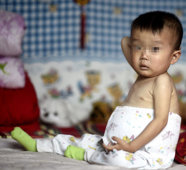 揪心，4岁孩子得怪病肚子不断胀大，妈妈爸爸为儿子别的都不顾了