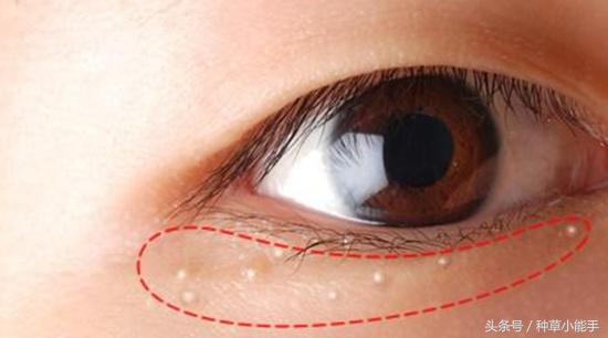 脂肪粒和眼霜有关吗,脂肪粒是不是不能用眼霜