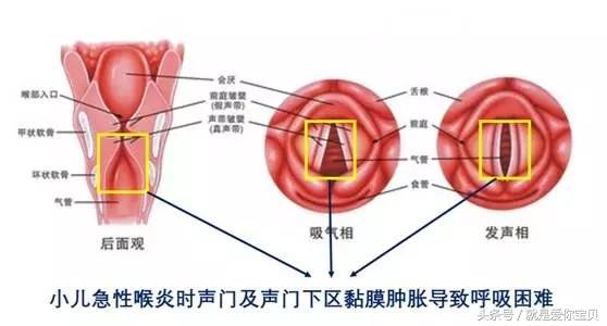 宝宝咳嗽怎么判断是否急性喉炎,小孩咳嗽空响都是急性喉炎吗