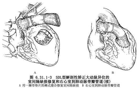 新生儿先心病手术后护理,先心病手术的婴儿怎么护理