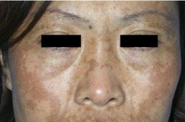 脸上的黄褐斑点怎么去除,脸上暗黄有斑怎么去掉啊