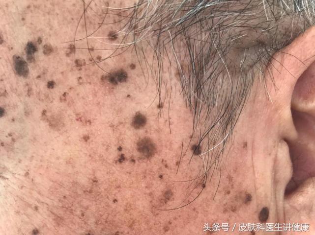 老年斑治疗骗局,养生堂治老人斑