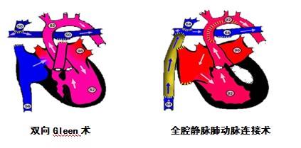 新生儿先心病手术后护理,先心病手术的婴儿怎么护理