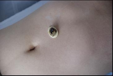 满满干货｜小小艾灸能量大，赶走酒瘾全靠它！