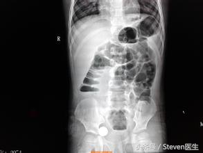 急性肠梗阻腹痛腹胀用什么药,急性肠梗阻引起的原因中医