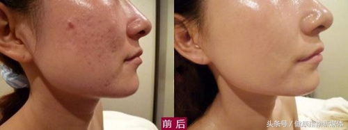 脸上的斑怎么才能去掉,脸上有片状斑怎么样才能去掉