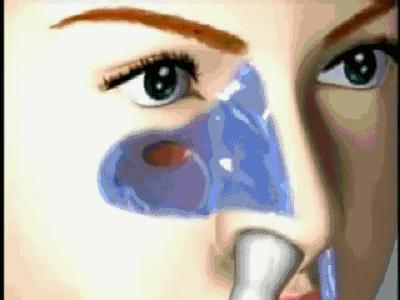 鼻出血鼻干燥,鼻出血与鼻炎有关吗