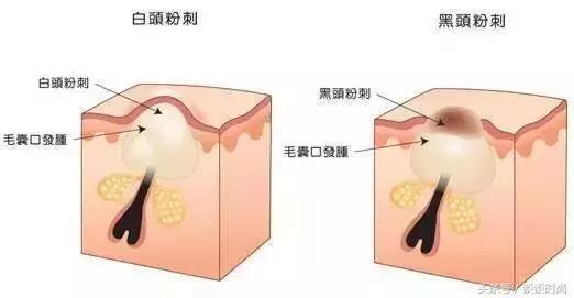 干货亲测最强去闭口攻略,亲身测评如何安全有效的去闭口