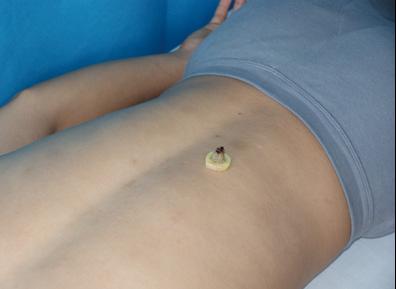 满满干货｜小小艾灸能量大，赶走酒瘾全靠它！