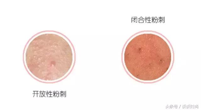 干货亲测最强去闭口攻略,亲身测评如何安全有效的去闭口