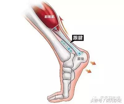 羽毛球跟腱断裂需要多久恢复,羽毛球跟腱杀手