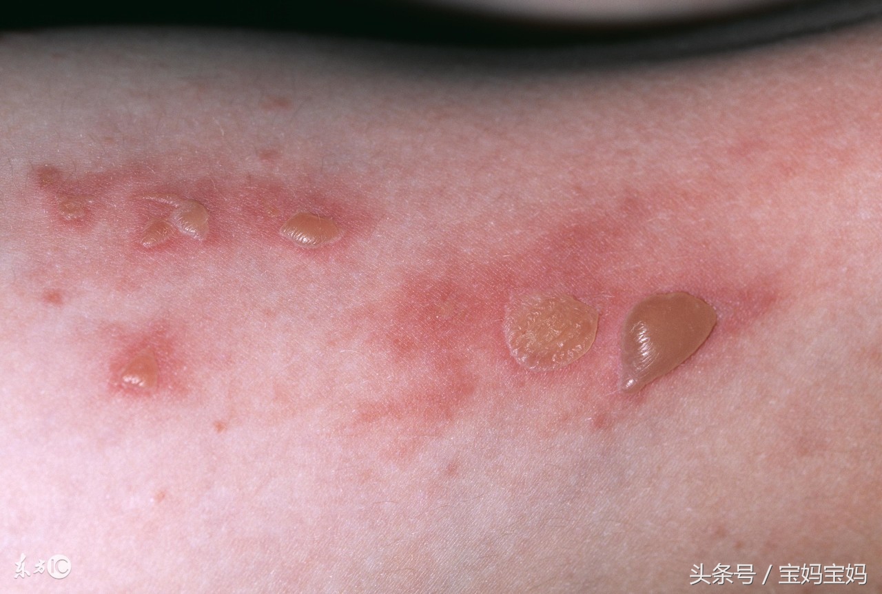 宝宝烫伤了怎么办？烫伤怎么避免和处理？