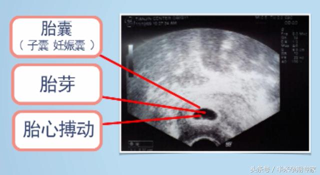 怀孕第一次b超看得到宝宝吗,孕早期几天b超才可以看到宝宝