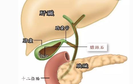 胆结石是什么原因造成的啊,胆结石形成原因3d视频
