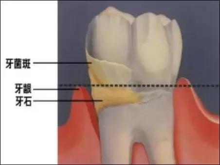 牙齿上长石头图片,你的牙齿还在吗