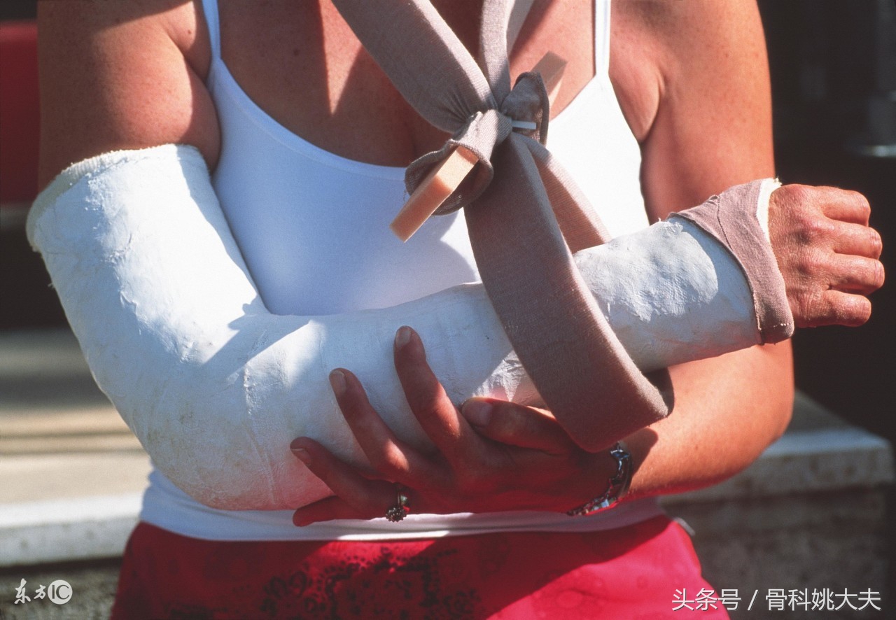 有外伤的骨折一个半月了还没愈合,同样的骨折有人几个月愈合