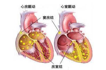 心脏房颤引起的脑梗该怎么治疗,医学教授讲治疗心脏房颤视频