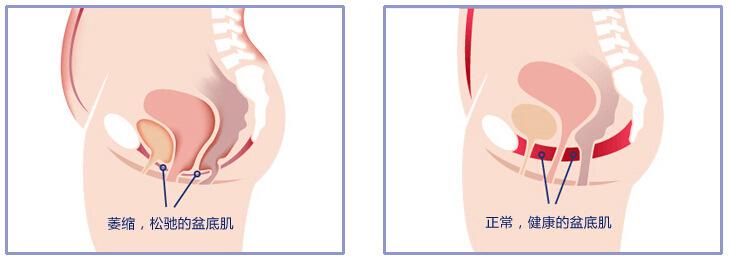 产后修复健身能恢复好身材吗,产后修复塑形瘦身