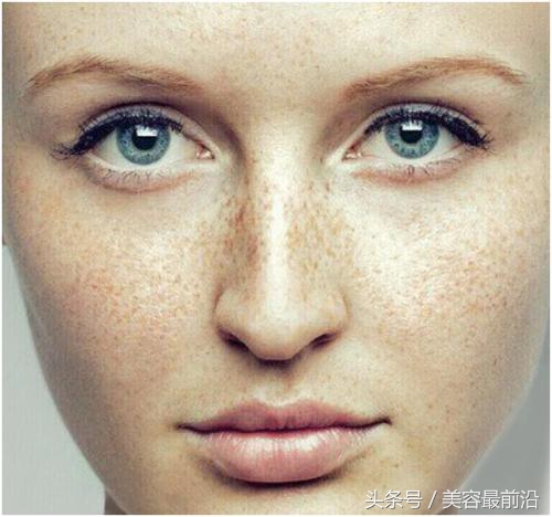 小孩脸上有雀斑怎么去掉,去掉脸上雀斑的最好办法
