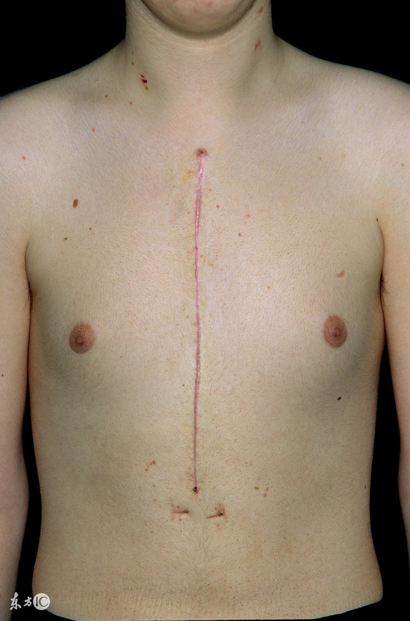 病毒性心肌炎的三大表现,病毒性心肌炎什么症状算最严重