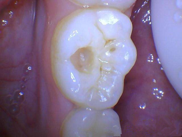 牙齿掉了什么时候补牙最好,牙齿缺了一半补牙要多少钱