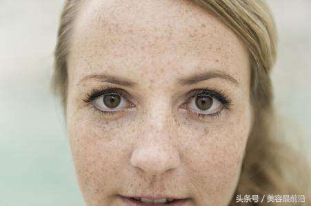 小孩脸上有雀斑怎么去掉,去掉脸上雀斑的最好办法